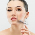 Can acne scar treatments completely remove scars?