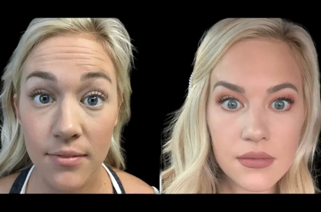 Why Botox Treatments in Dubai Are Becoming a Beauty Essential