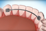 What Are the Signs Your Retainer Needs Adjustment?