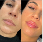 Best Doctors in Dubai for Fillers and Youthful Skin
