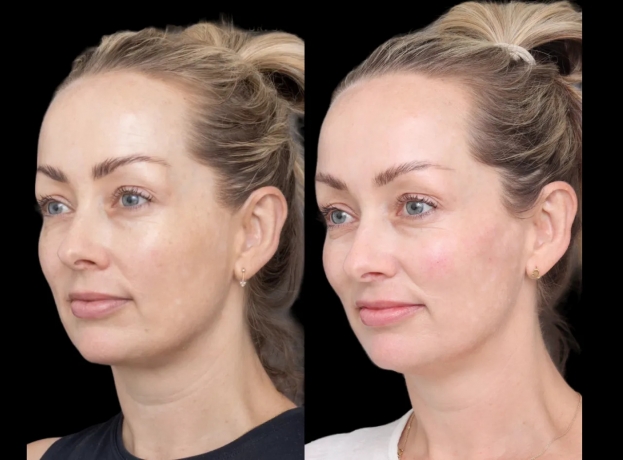 How the Best Doctors in Dubai Deliver Quick and Effective Cheek Fillers Treatments