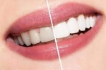 Are There Any Side Effects of Nano Teeth Whitening?