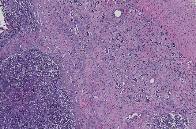 Merkel Cell Carcinoma Market to Grow at Highest Pace Owing to Immunotherapy Advancements