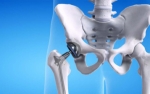 Regain Mobility and Comfort with Hip Joint Replacement Surgery in Pune