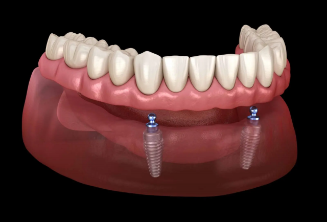Full Mouth Dental Implants Cost Tips for Maximum Savings Today