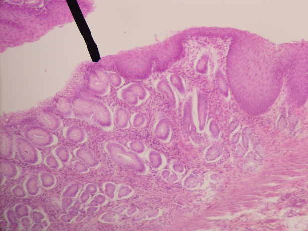 Advanced Non-Squamous and Squamous NSCLC Market to Grow Fast 