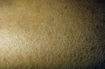 Lamellar Ichthyosis Market to Grow with Gene Therapy Solutions