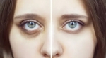 Types of Hyaluronic Acid Fillers Commonly Used for Under-Eye Concerns in Dubai Clinics