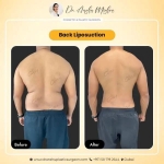 Transform Your Body with Expert Liposuction in Dubai by Dr. Hans