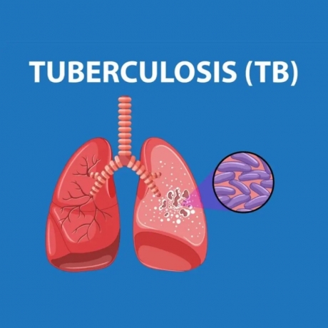 Find the Best TB Doctor in Varanasi for Effective Tuberculosis Treatment