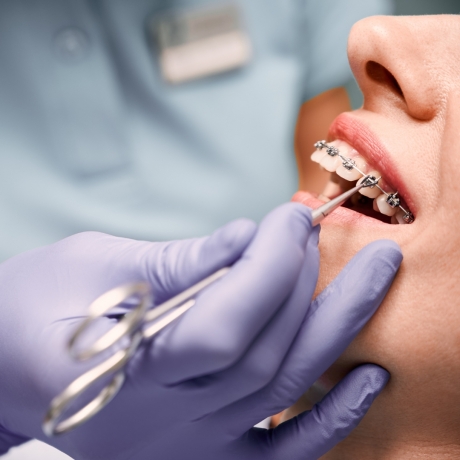 How Much Are Braces? Breakdown of Costs for Metal, Ceramic, and Invisalign