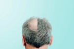 Medical Tourism for Hair Transplants in Abu Dhabi: Why the Capital is Attracting Global Patients