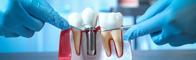 Can I Get Dental Implants in Dubai If I Have Gum Disease