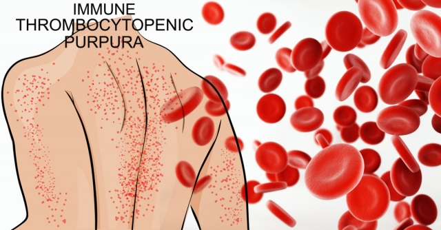 Immune Thrombocytopenia Treatment Market to Grow Rapidly Owing to Novel Biologic Therapies