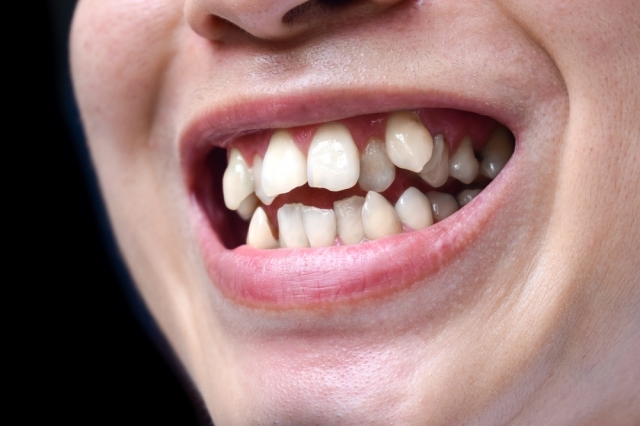 The Clear Aligners Revolution: A New Era in Straightening Teeth