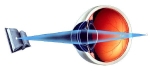 Presbyopia Treatment Market to Grow Rapidly with Advanced Drug Formulations