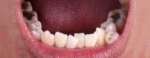 Are Overlapping Teeth Considered a Dental Problem?
