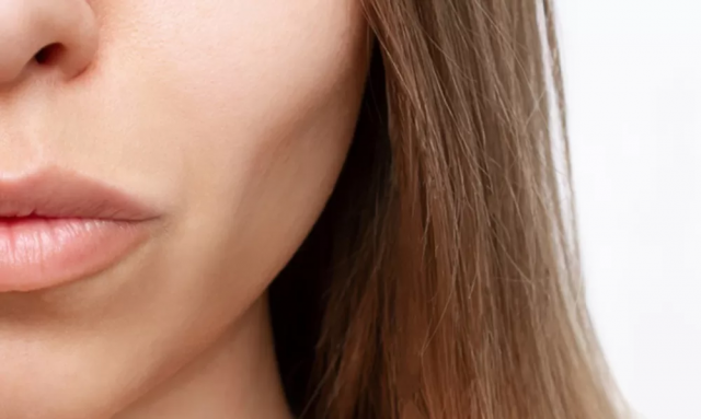 Does Sculptra Fillers Define Cheek Structure?