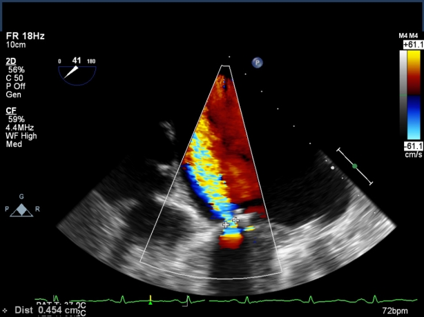 Guide to Paravalvular Leak