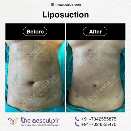 Achieve a Sculpted Look with Liposuction Surgery in India at Theaesculpir