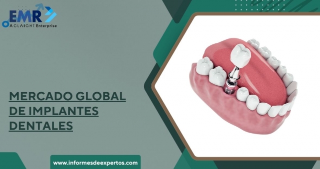 Perspectivas y Tendencias del Mercado Global de Implantes Dentales