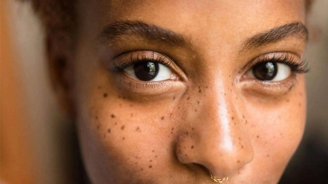 Does Mole Removal Treatments Cause Redness?