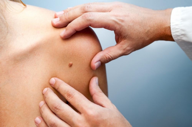 Effective Laser Wart Removal: Your Solution to Clear Skin