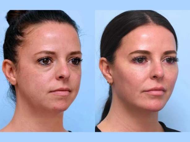 Thread Lift Aftercare: Essential Tips from the Best Aesthetic Clinic in Dubai