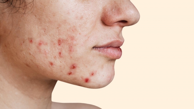 A Deep Dive into Acne Treatment Solutions in Dubai