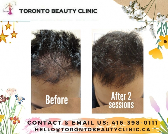 A Simple Guide To PRP Treatments Toronto!