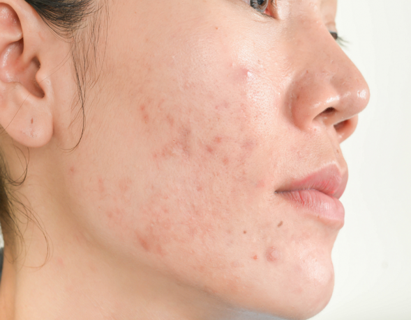 Your Acne-Free Skin Journey Starts in Dubai