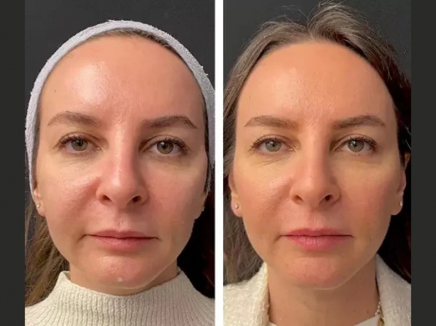 Top Benefits of Mesotherapy Explained by the Best Plastic Surgeons in Dubai