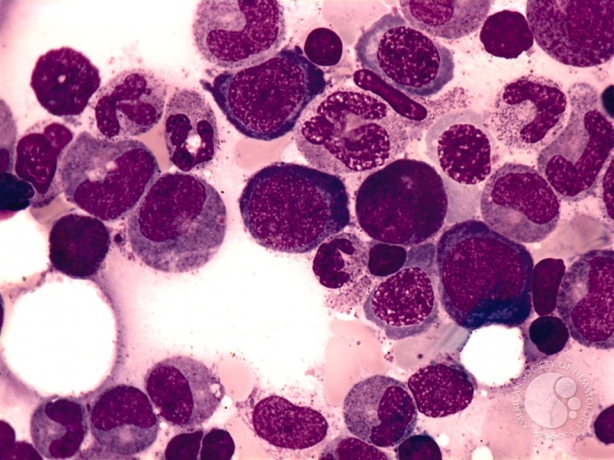 Aplastic Anemia Market to Surge with Gene Therapy Opportunities