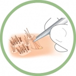 Understanding the Best Hair Transplant Techniques: A Guide by a Leading Hair Specialist in Ludhiana