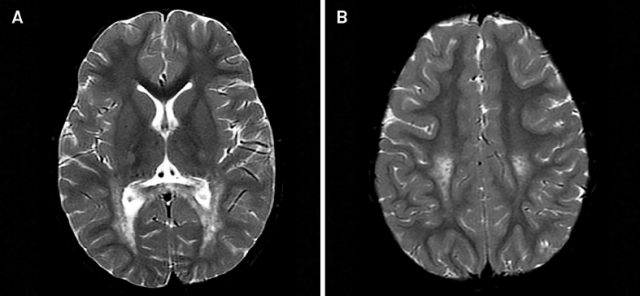 Krabbe Disease Market Surges by Gene Therapy Advancements