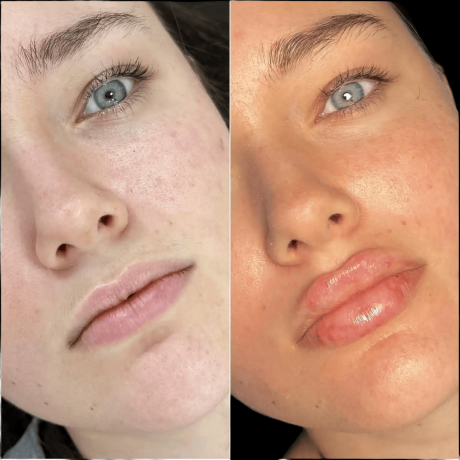 Best Aesthetic Clinic in Dubai for Fillers: Transform Your Look