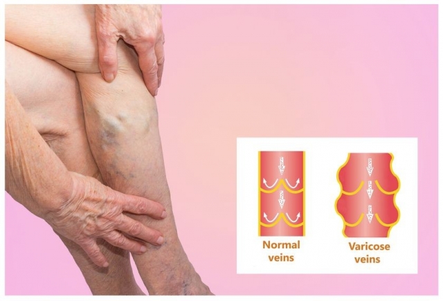 Can Varicose Veins Go Away