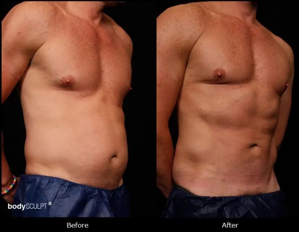Top Benefits of Abdominal Liposuction After Weight Loss