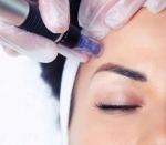 Microneedling Facial Norwich Reviews: Real Stories, Real Results!