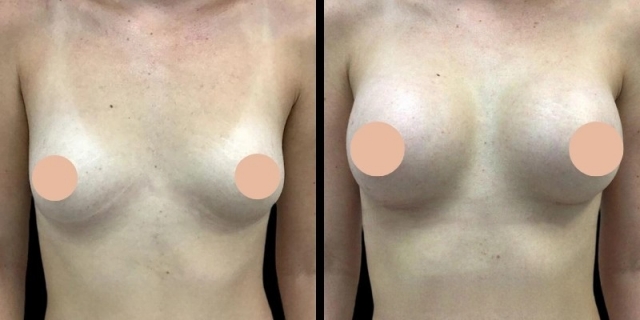 Best Breast Augmentation Surgeon in Dubai for Personalized Surgical Plan