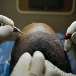A Beginner’s Guide to Hair Transplant in Islamabad