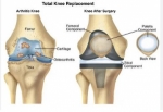 From Pain to Relief: All about Knee Replacement Surgery – Procedure, Types & Risks.