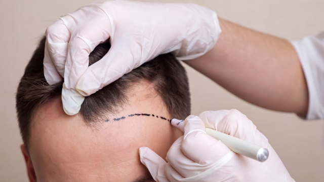 Revive Your Crown with Hair Transplant in Dubai
