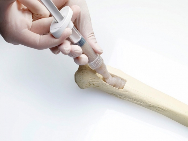 Bioactive Materials Market Growth Fueled by Bone Graft 