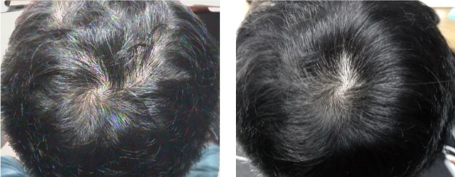 Achieving Beautiful Tresses: Exploring the Benefits of Keralase for Hair Restoration