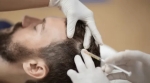 Hair Loss Treatment Market Growth Driven by Innovations