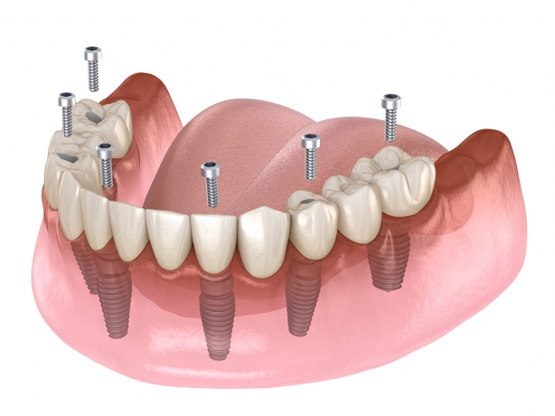Uncover the Truth About Full Mouth Dental Implants Cost Today