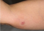 Merkel Cell Carcinoma Market Gains from Immuno-oncology Therapies