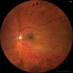 Proliferative Diabetic Retinopathy Market Surges with Anti-VEGF Therapy