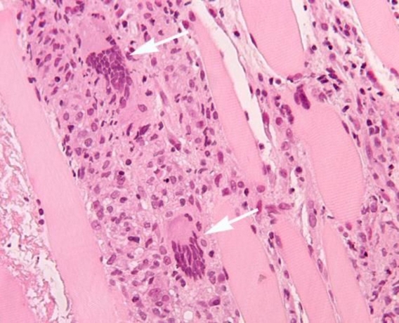 Evolving Inflammatory Myositis Diagnosis Market Outlook 2025-2032